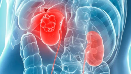 Böbrek Kanseri Tedavisi